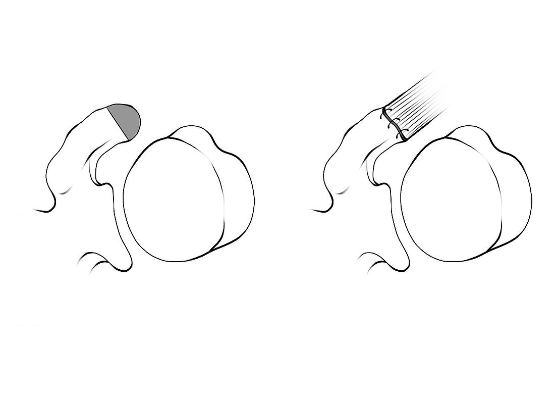 Coracoid process shoulder surgery, illustration