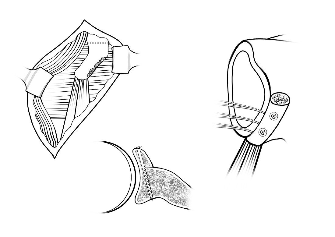 Modified Laterjet procedure shoulder surgery, illustration