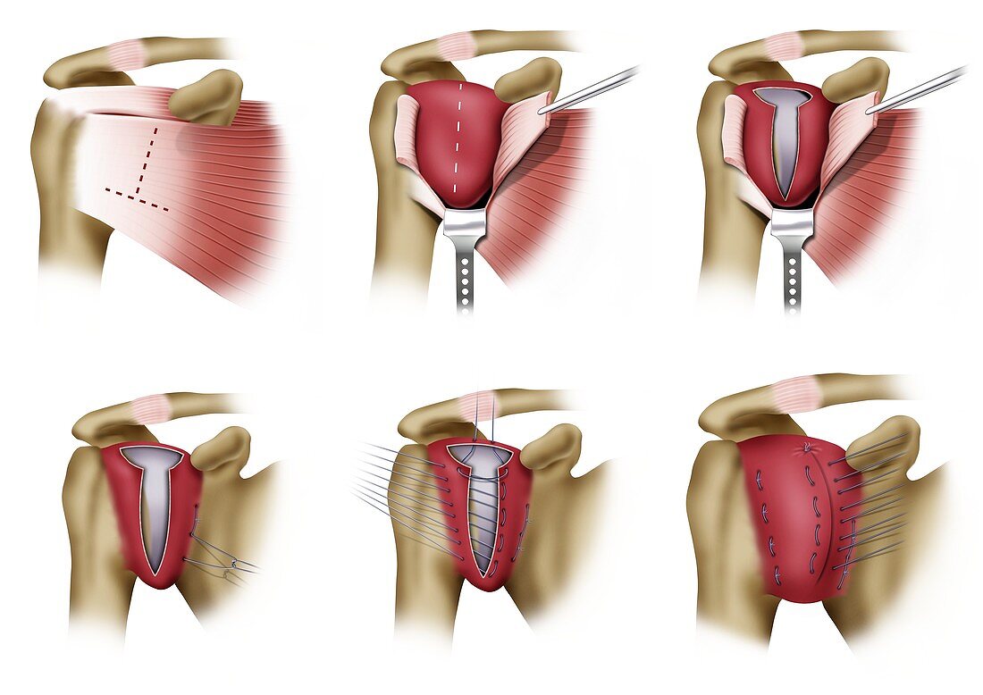 Glenoid cavity shoulder surgery, illustration