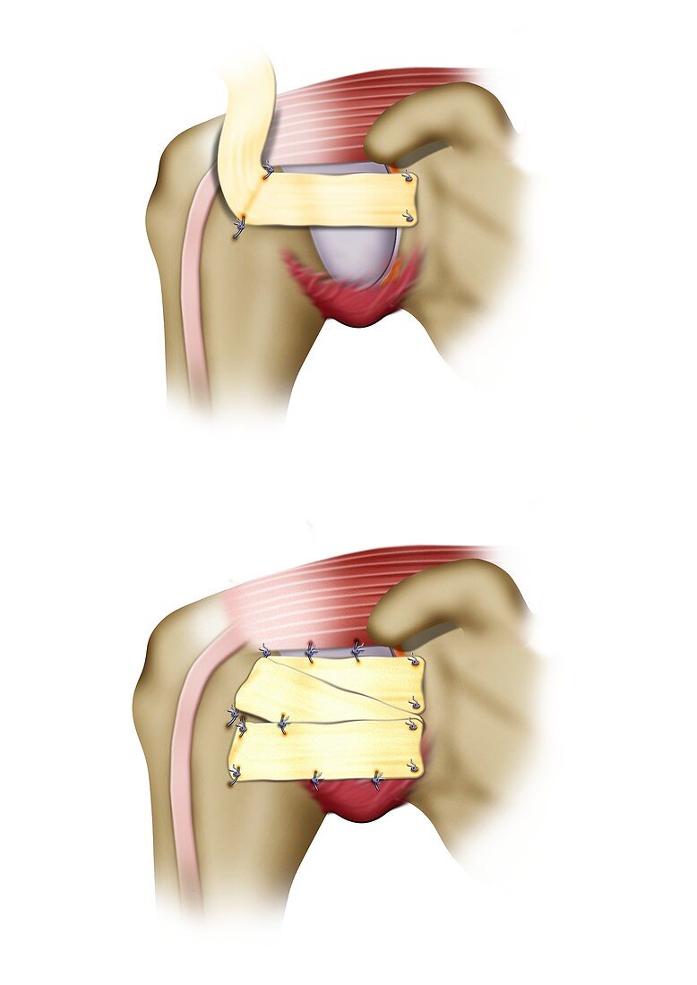 Iannotti procedure shoulder surgery, illustration