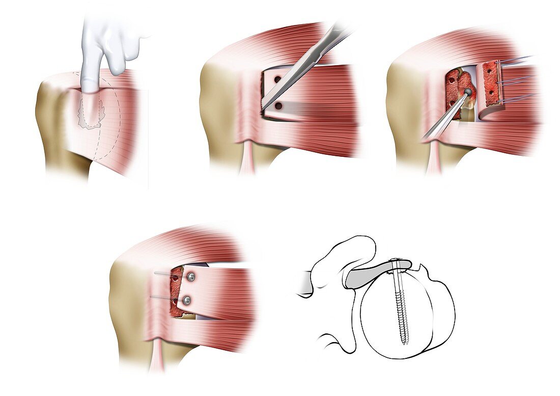 Mclaughlin procedure shoulder surgery, illustration
