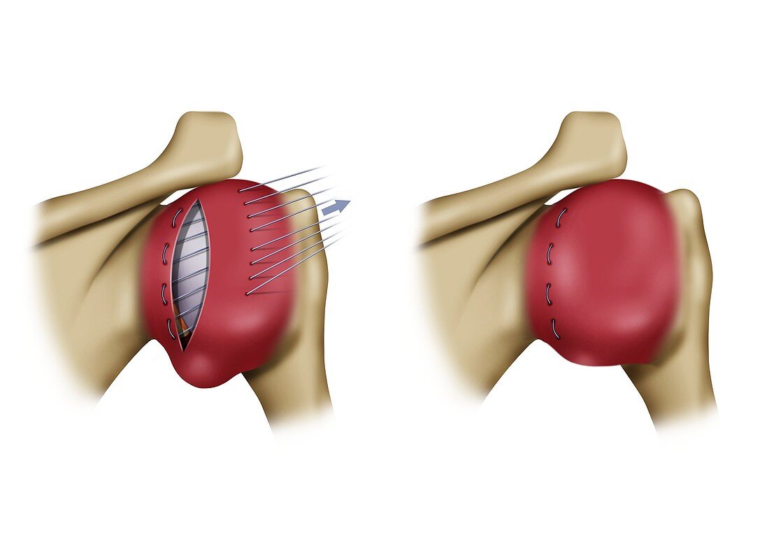 Rockwood disorder shoulder surgery, illustration