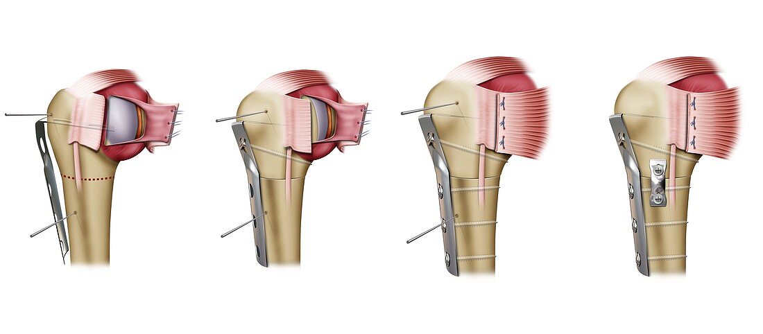 Weber procedure shoulder surgery, illustration
