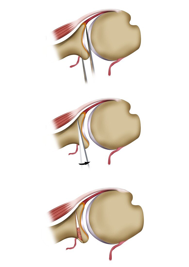 Glenoid osteotomy shoulder surgery, illustration