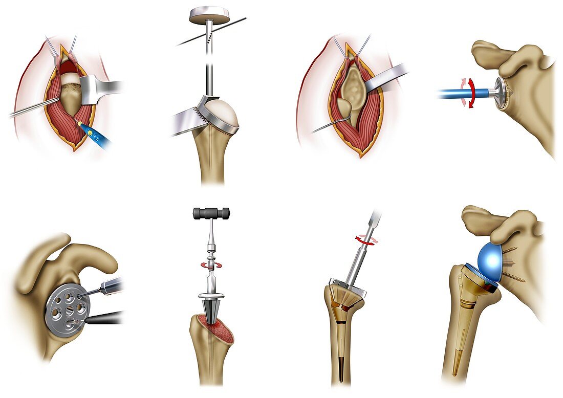 Humeral prosthesis shoulder surgery, illustration