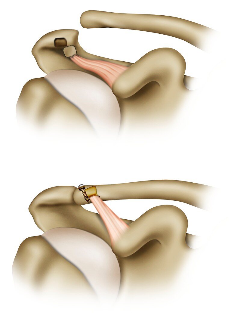 Clavicle ligament shoulder surgery, illustration