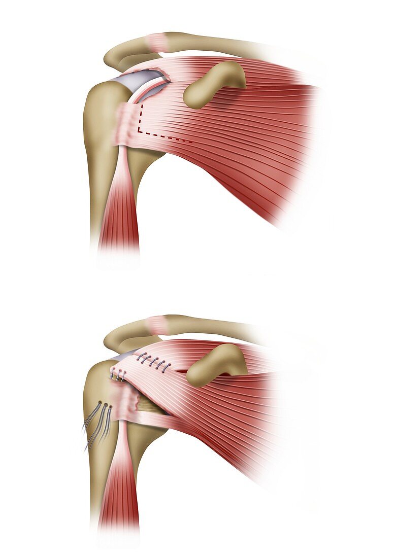 Shoulder muscles surgery, illustration