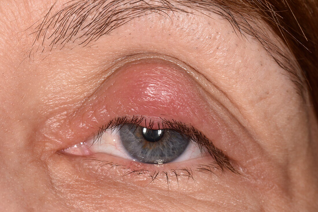 Chalazion cyst on an eyelid