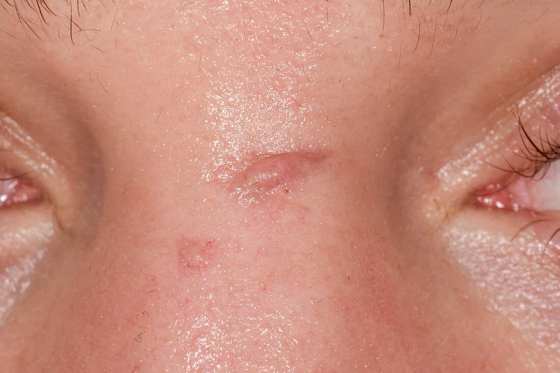 Keloid scarring