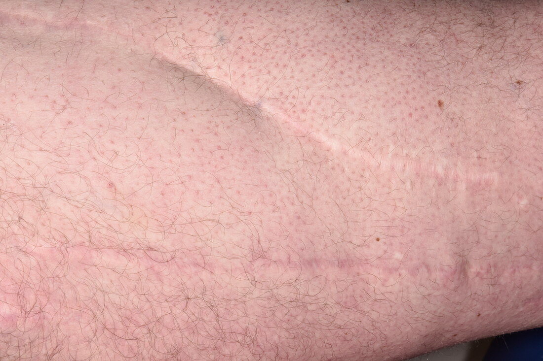 Scars from knee surgery