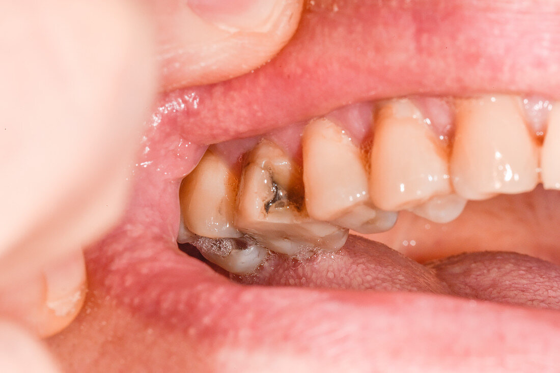 Broken molar tooth