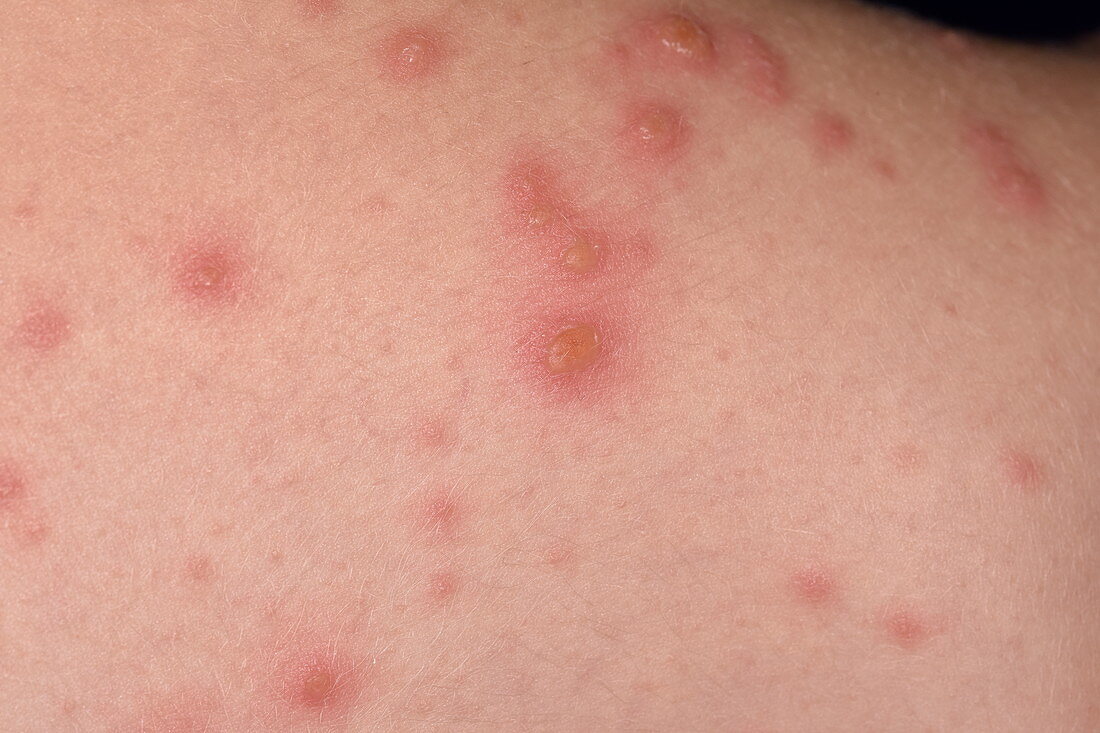 Chickenpox lesions