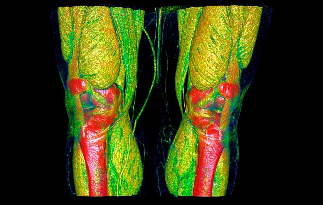 Knee joints and muscles, 3D CT scan