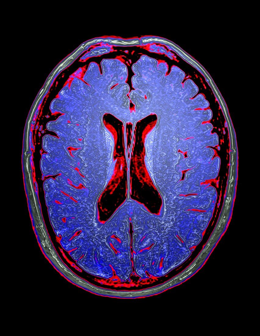 Human brain, axial MRI scan