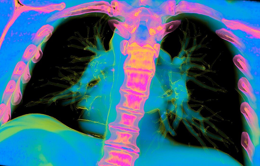 Heart and lungs, 3D CT scan