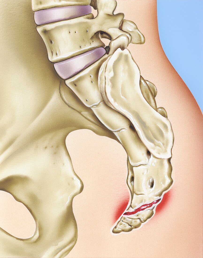 Fracture of the coccyx, illustration – acheter une photo ...