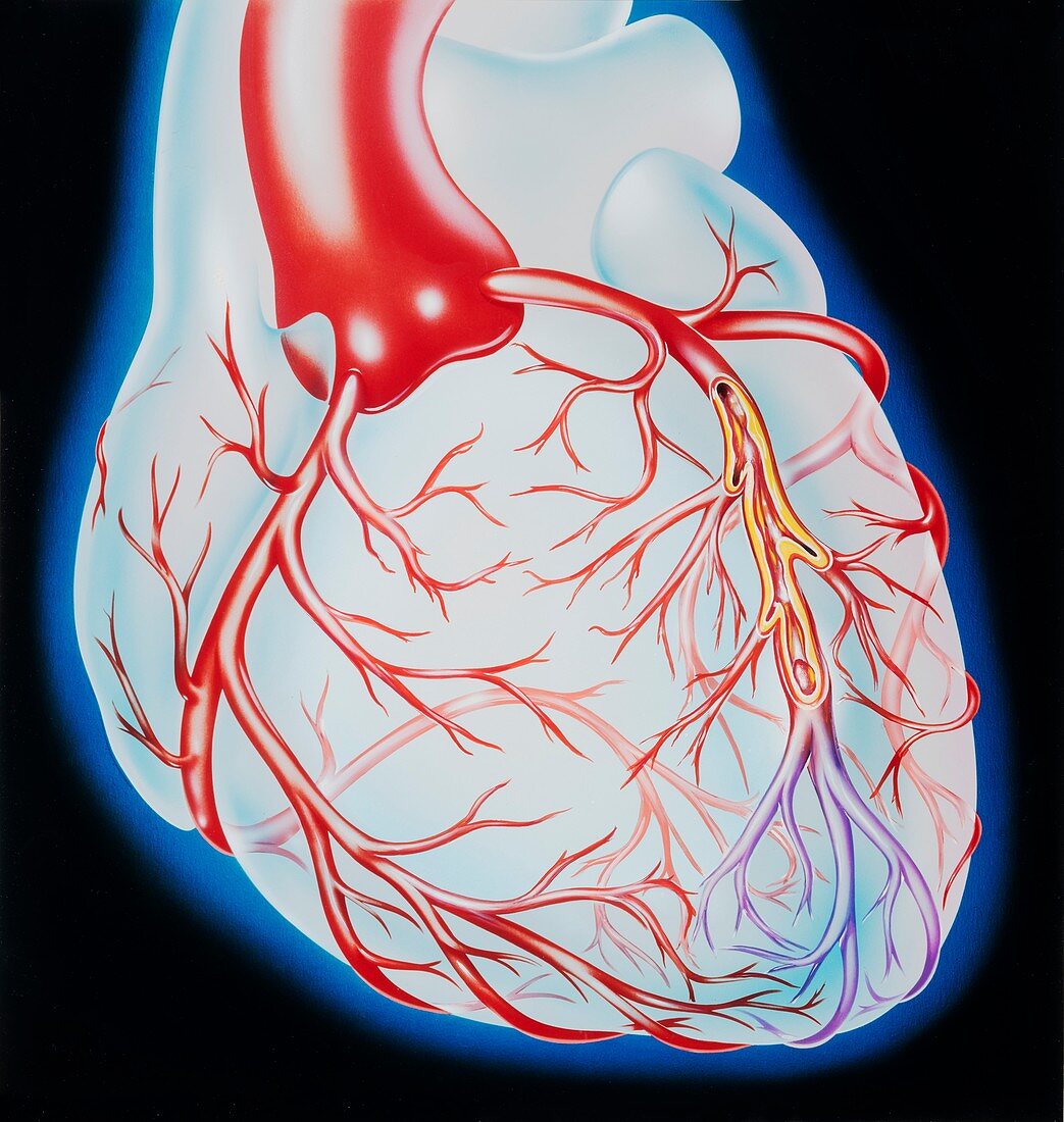 Coronary artery occlusion in heart attack, illustration