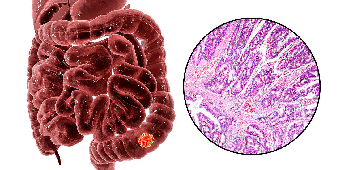 Colon cancer, composite image