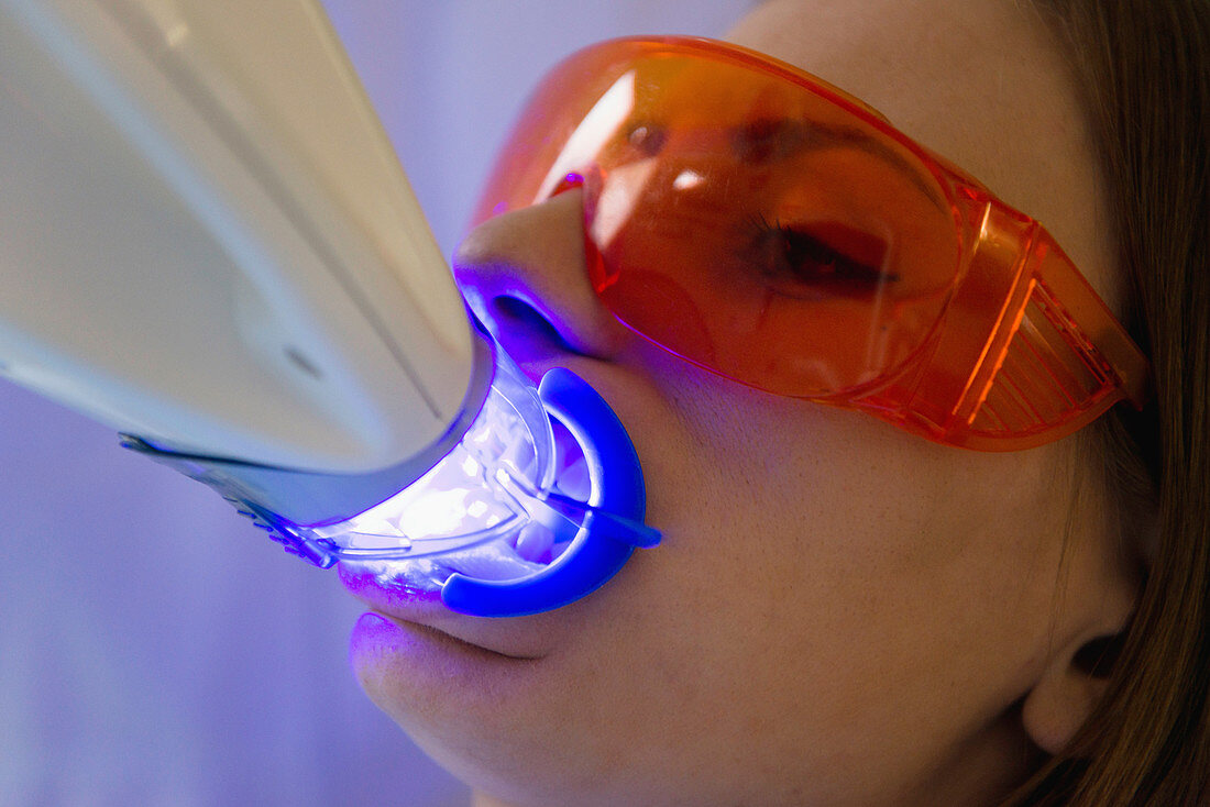 Laser teeth whitening