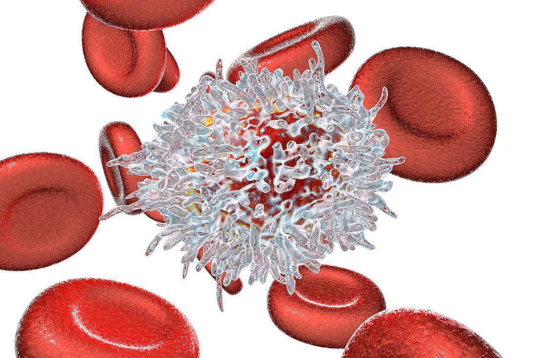 Lymphocyte in hairy cell leukaemia, illustration