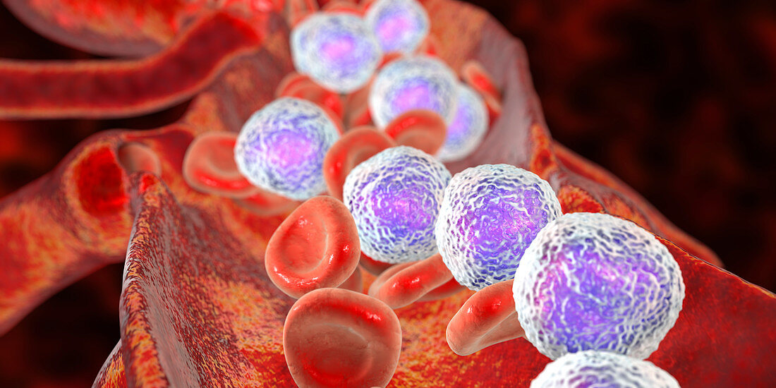 Acute lymphoblastic leukaemia, illustration