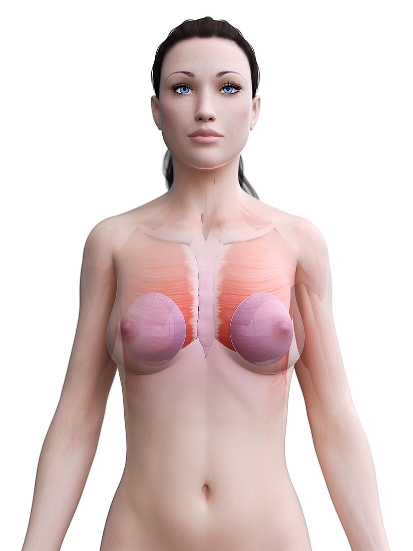 Breast implants, illustration