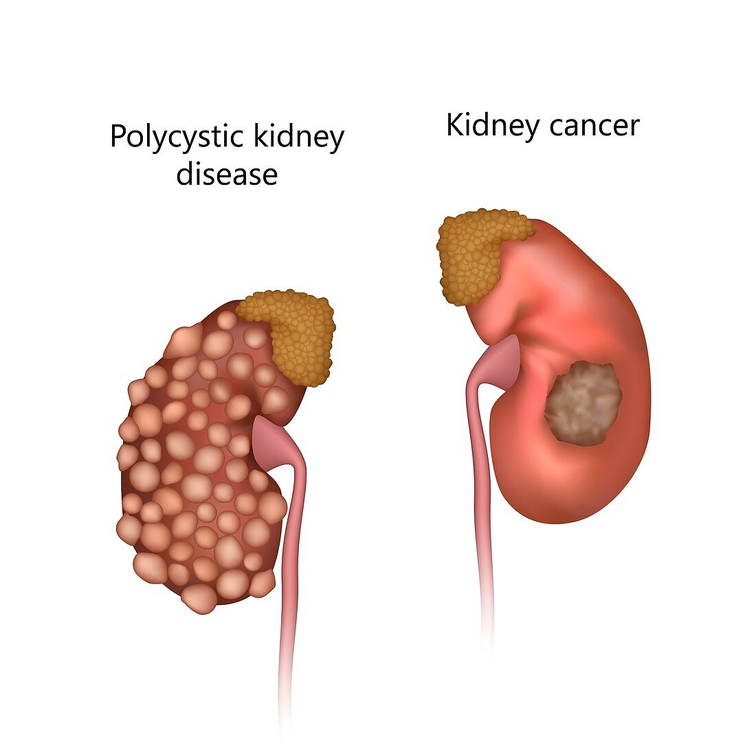 Polycystic kidney disease and kidney cancer, illustration