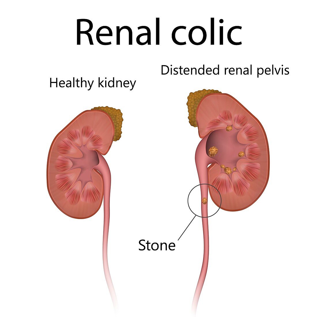Healthy kidney and kidney with renal colic, illustration