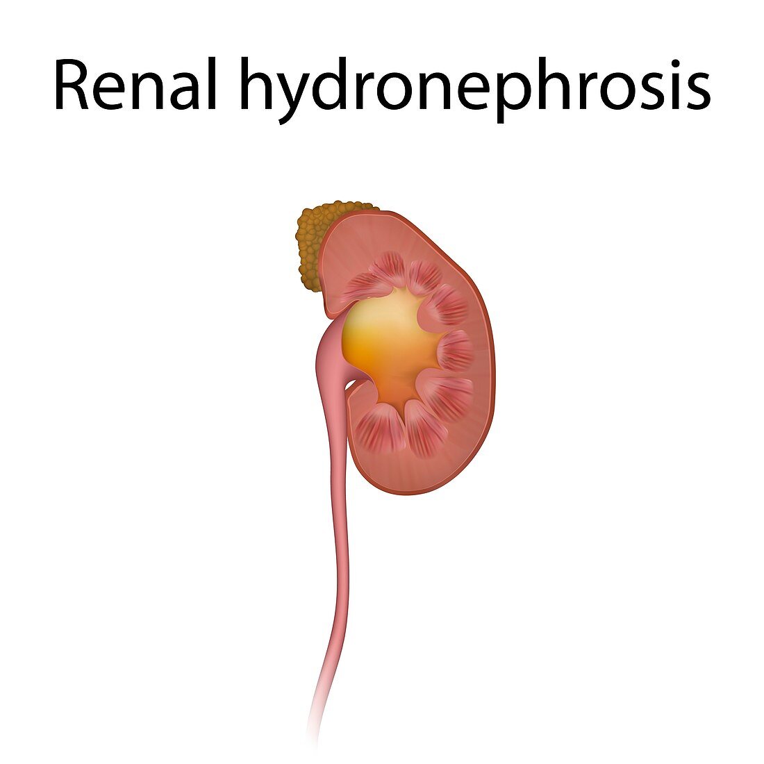 Renal hydronephrosis, illustration
