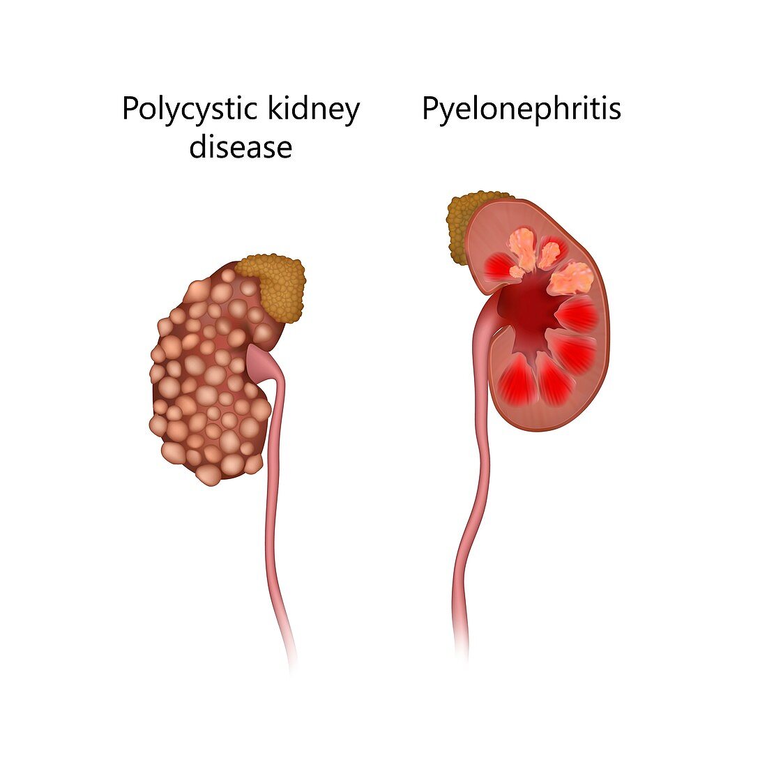 Polycystic kidney disease and pyelonephritis, illustration
