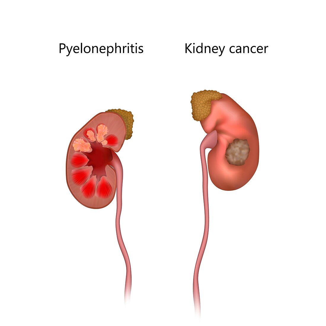 Pyelonephritis and kidney cancer, illustration