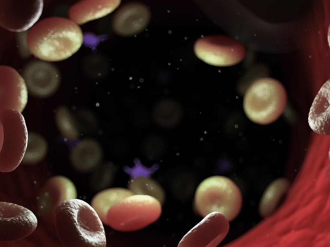 Diseased blood cells, illustration