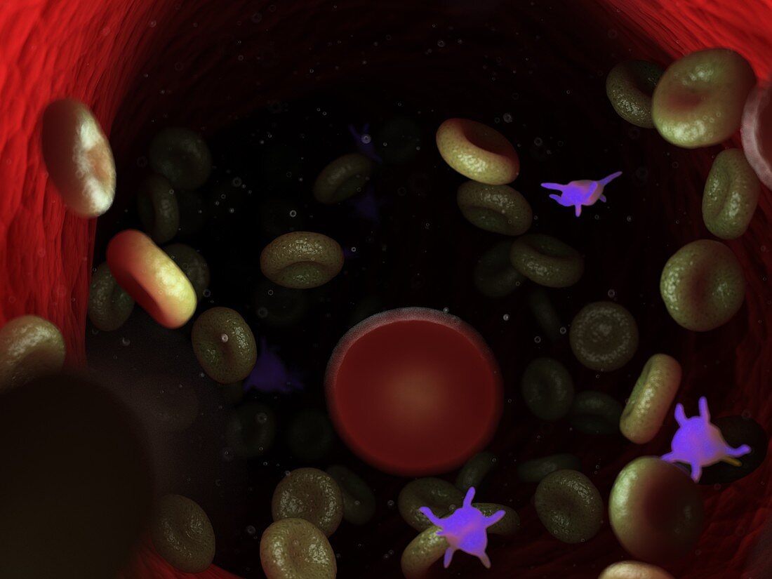 Diseased blood cells, illustration