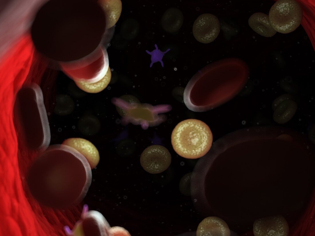 Diseased blood cells, illustration