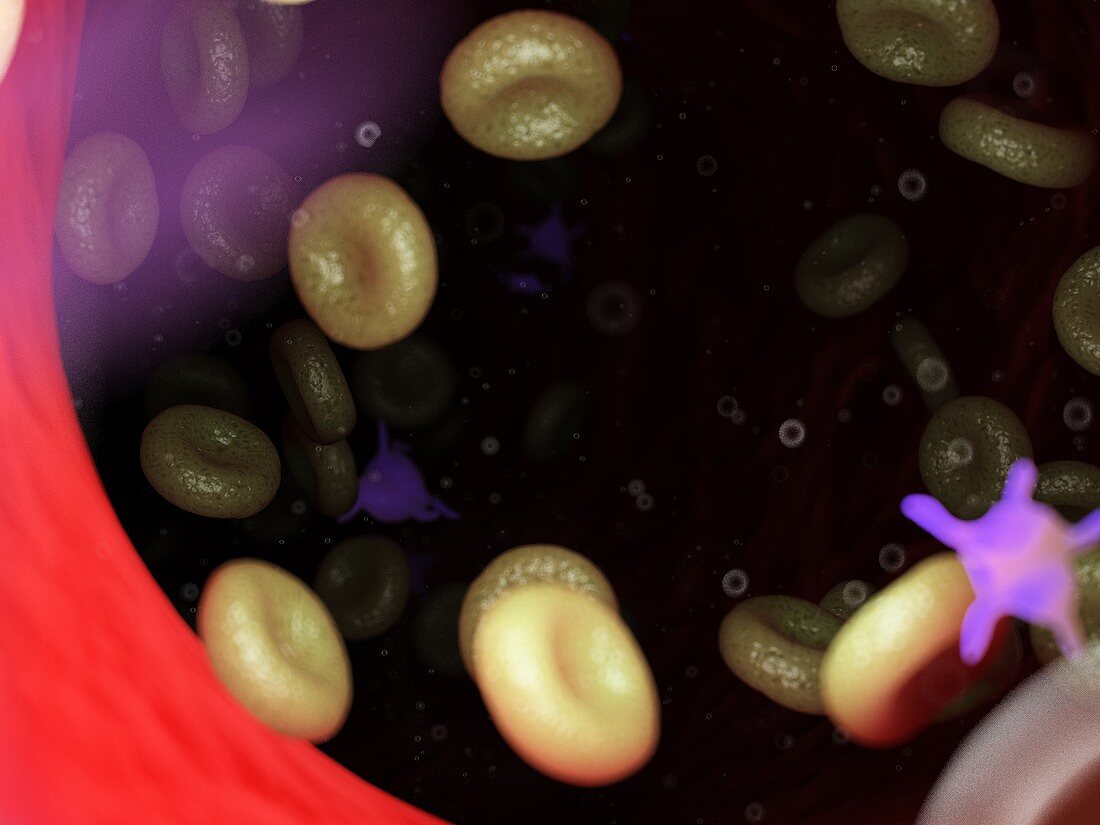 Diseased blood cells, illustration