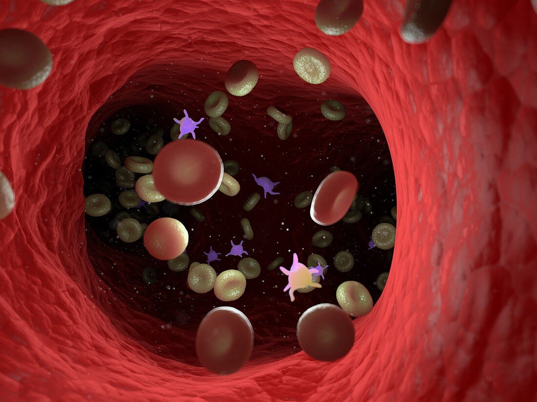 Diseased blood cells, illustration