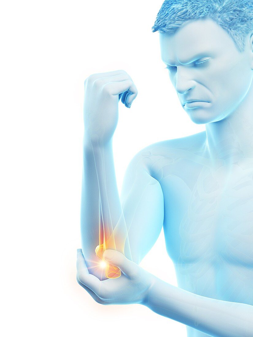 Elbow pain, conceptual illustration