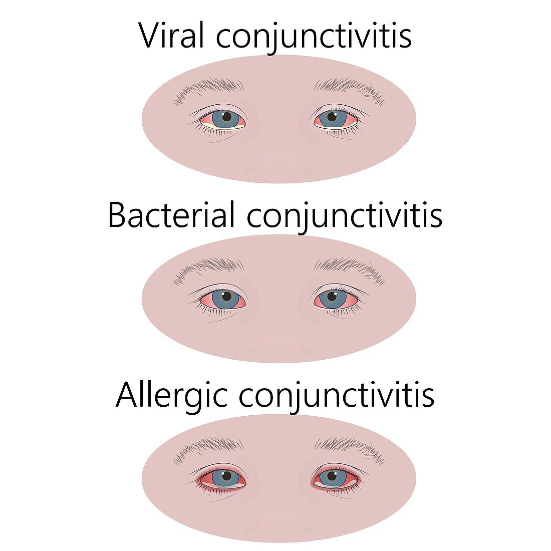Types of conjunctivitis, illustration