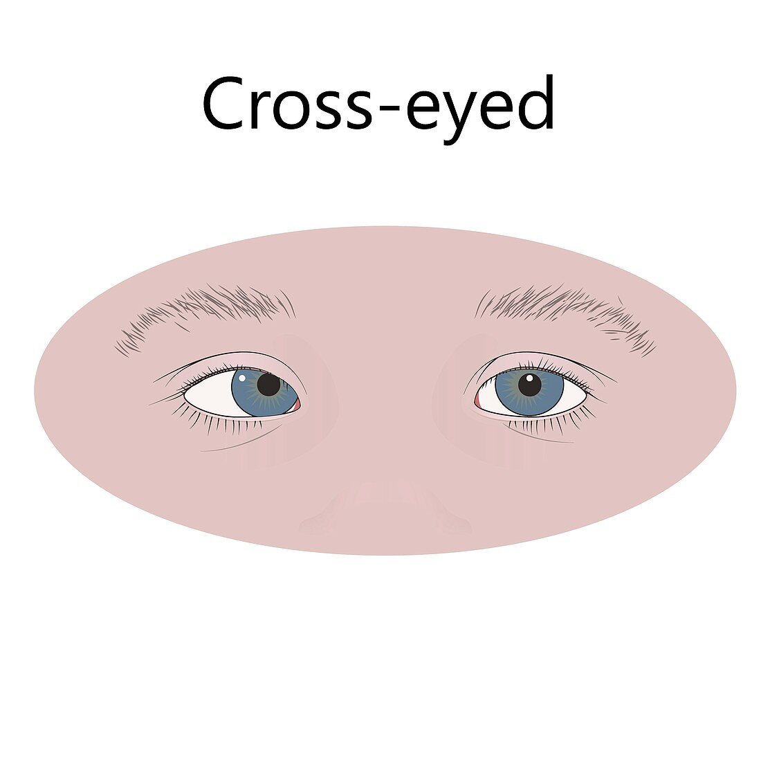 Cross-eyed child, illustration