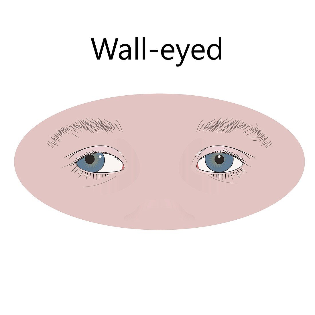 Wall-eyed child, illustration