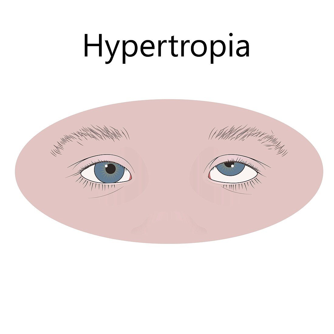 Childhood hypertropia, illustration
