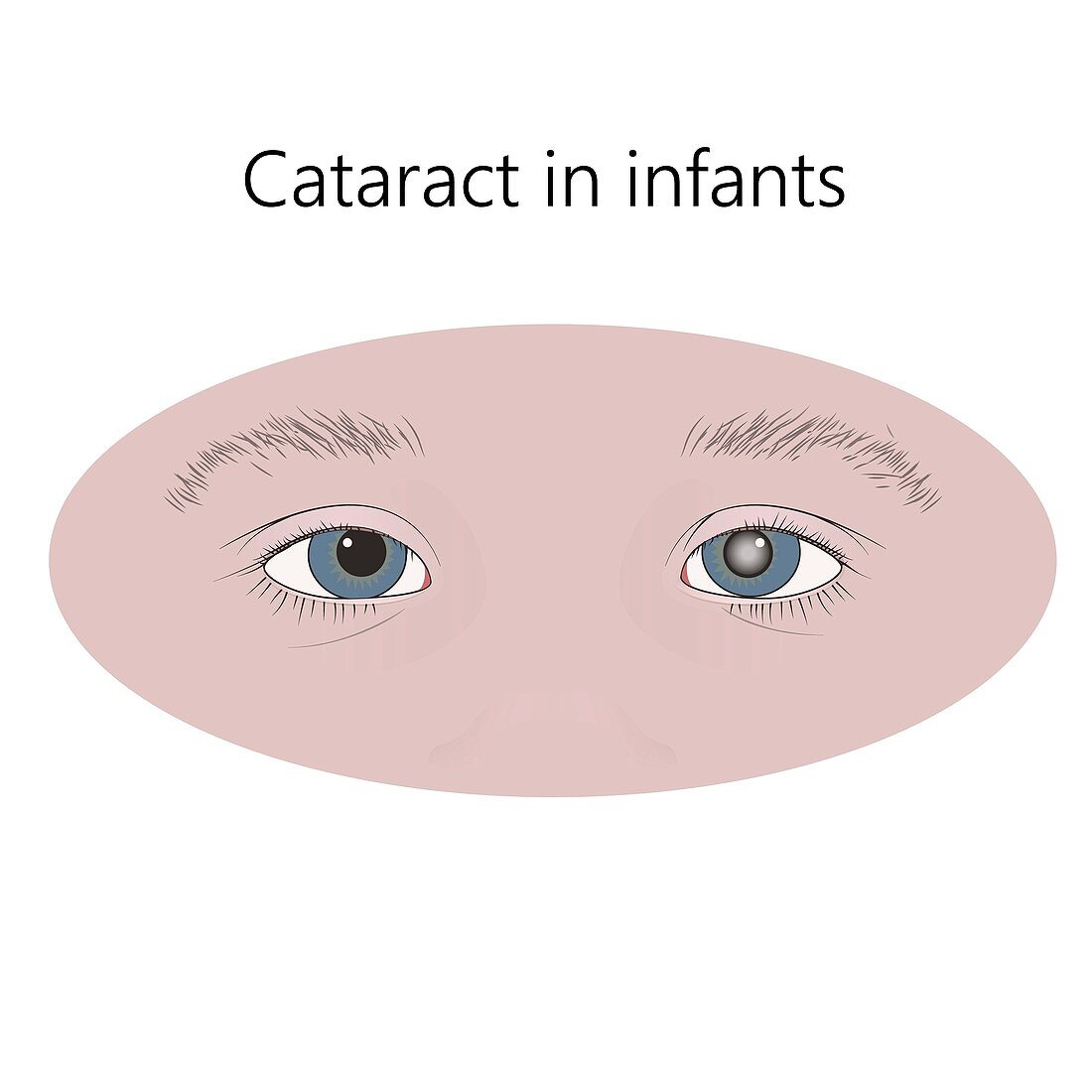 Childhood cataract, illustration