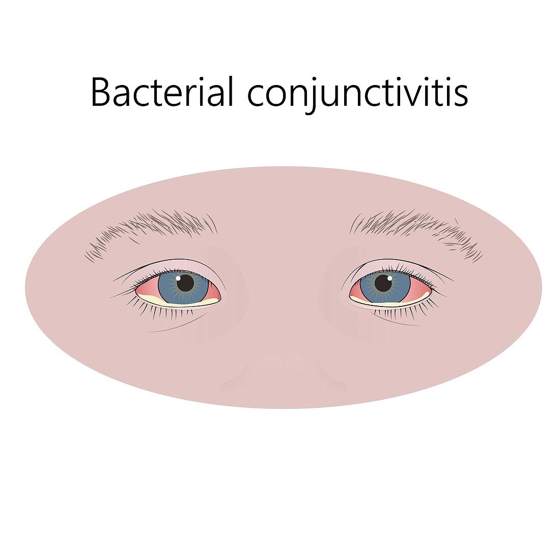 Bacterial conjunctivitis, illustration