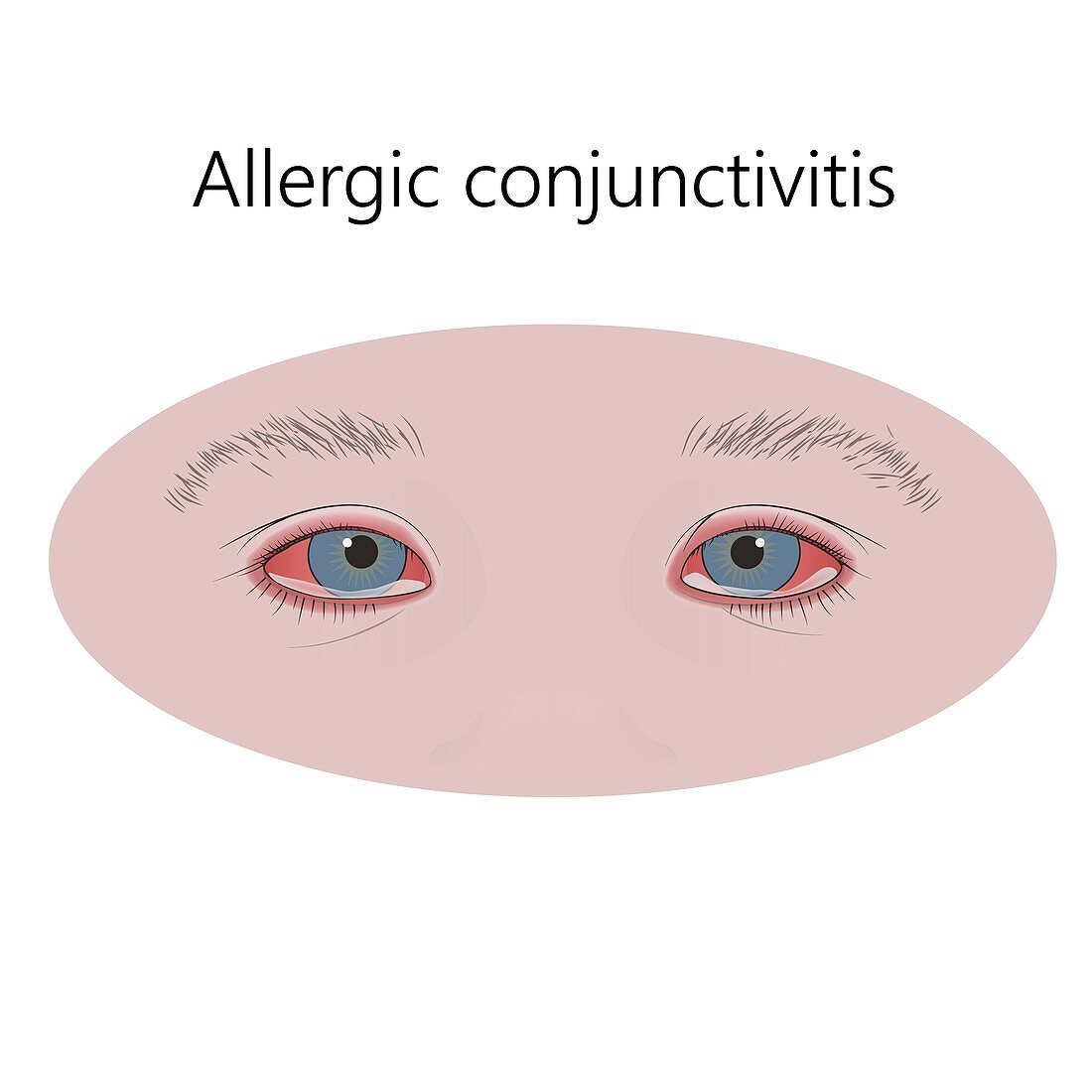 Allergic conjunctivitis, illustration