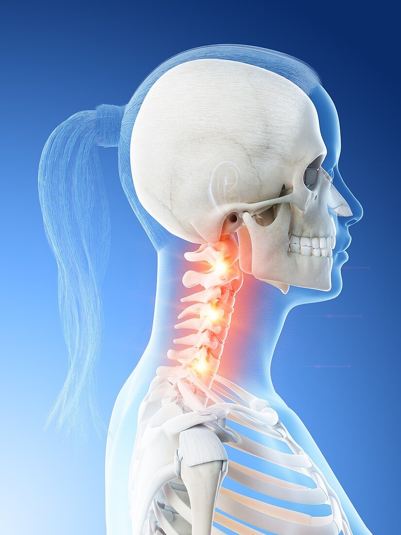 Neck pain, conceptual illustration