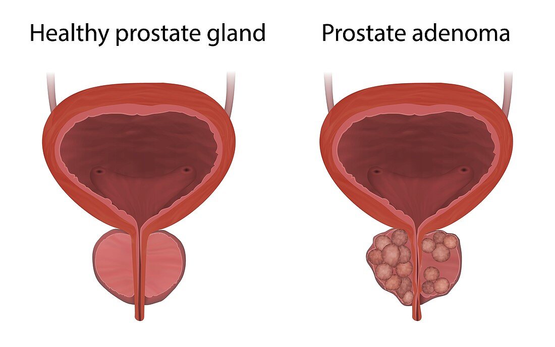 Prostate adenoma and healthy prostate gland, illustration