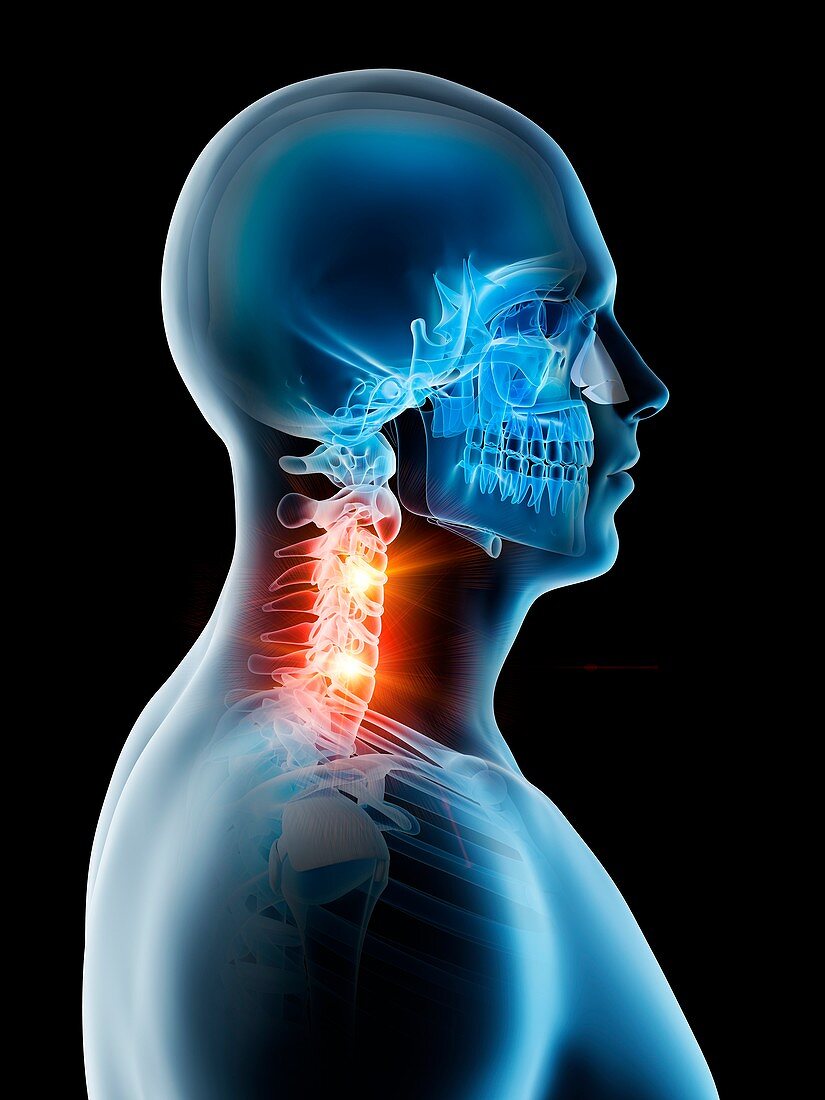 Neck pain, conceptual illustration