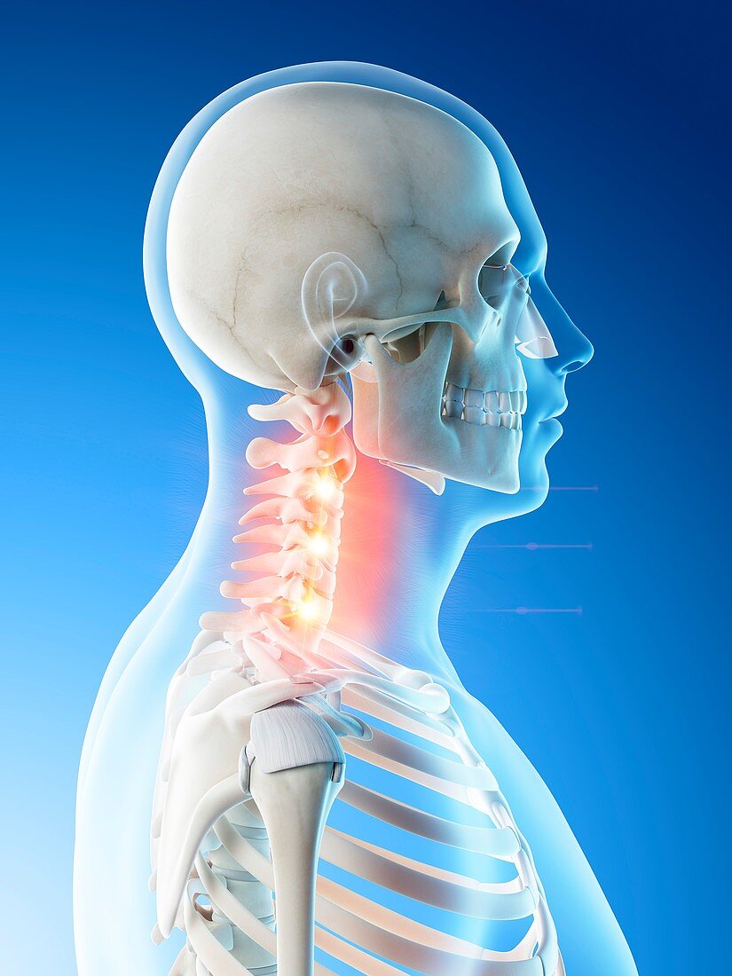 Neck pain, conceptual illustration