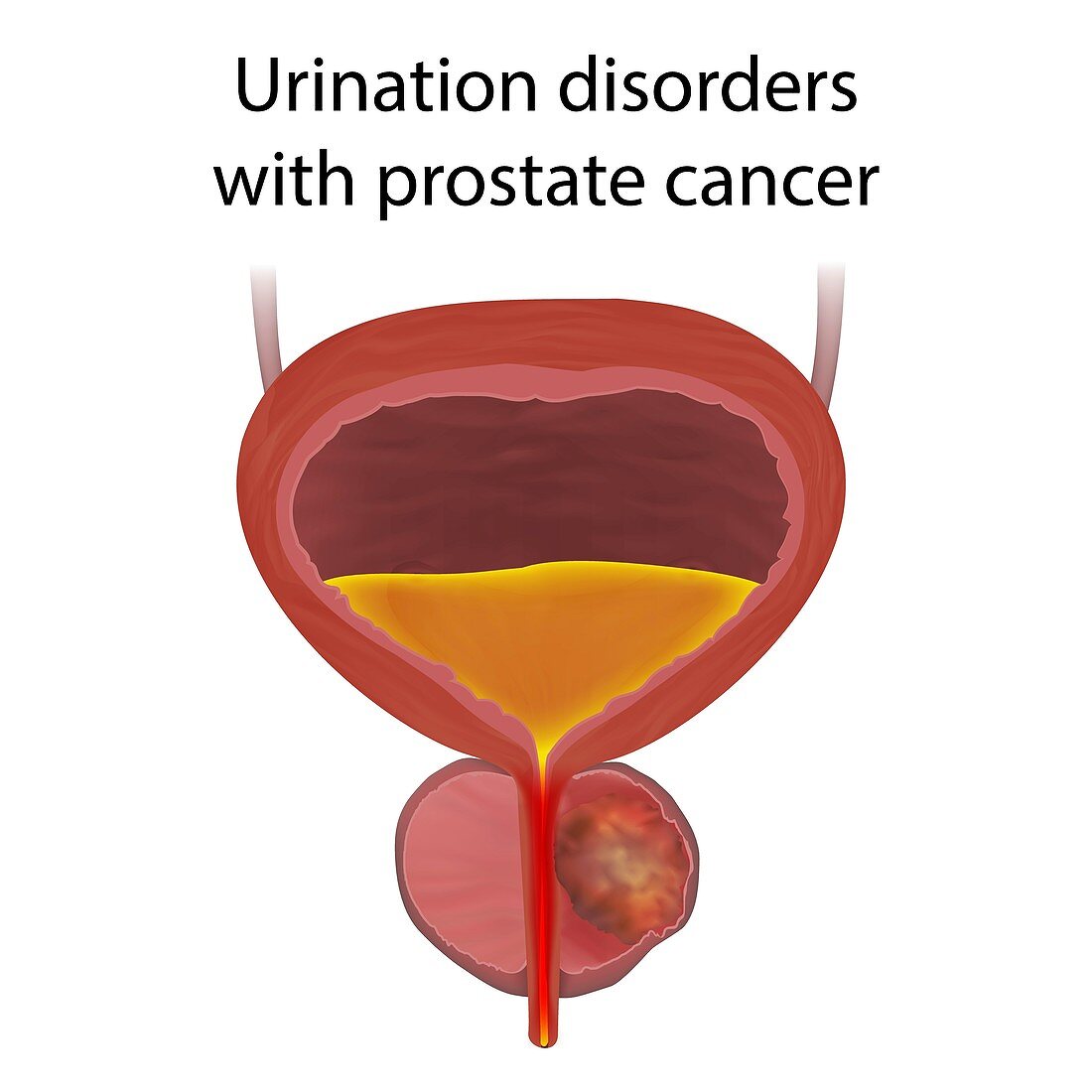 Urinary disorders with prostate cancer, illustration