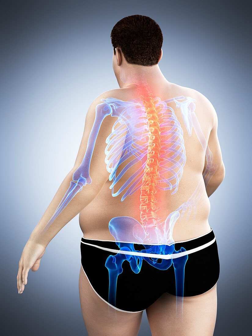 Obese man with back pain, illustration